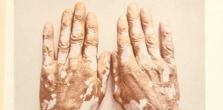 O vitiligo causa a despigmentação da pele