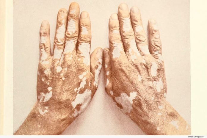 O vitiligo causa a despigmentação da pele